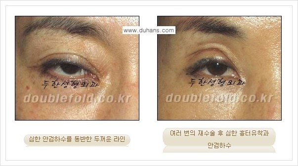 [두한성형외과 경쟁력 쌍꺼풀 재수술, 극한 재수술] - [망친 눈 복원 극한 재수술] 관련 이미지 2