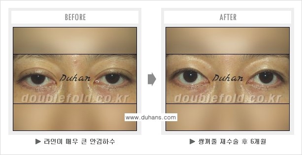 [두한성형외과] - [쌍꺼풀 재수술에서 매우높은 흉터선의 처리 문제] 관련 이미지 5