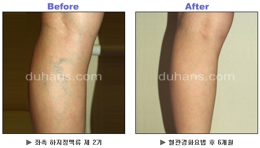 [두한성형외과 정맥류] - [하지정맥류, 정맥확장증, 혈관확장증] 관련 이미지 21
