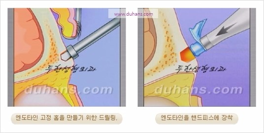 [두한성형외과 주름성형] - [주름교정술 - 강력한 리프팅 파워 엔도타인 리프팅 ] 관련 이미지 31