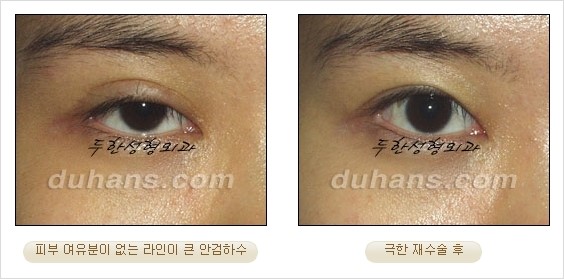 [두한성형외과 경쟁력 쌍꺼풀 재수술 리더 ] - [쌍꺼풀 재수술 과정, 쌍꺼풀 재수술 실패의 원인, 극한 재수술] 관련 이미지 21