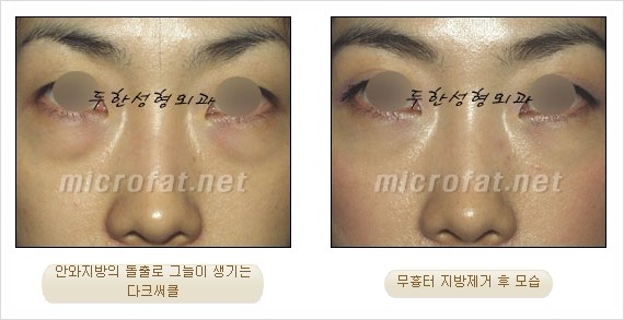 [두한성형외과 쌍커풀수술] - [눈성형 방법에 대한 자주하는 질문과 답변] 관련 이미지 160