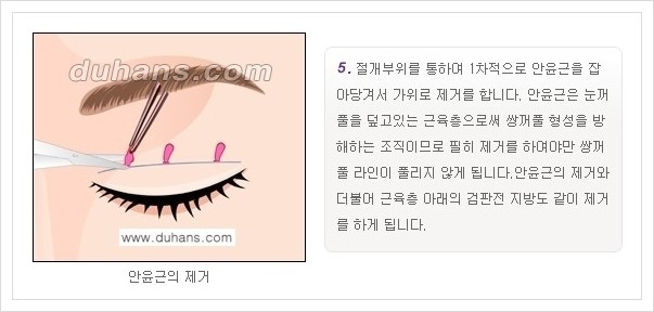 [두한성형외과 경쟁력 눈성형] - [퀵쌍꺼풀 안내] 관련 이미지 6
