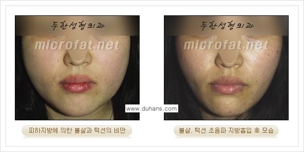 [두한성형외과 겨울엔 지방흡입을] - [볼살, 눈밑, 턱선의 초음파 미세지방흡입 1.] 관련 이미지 8