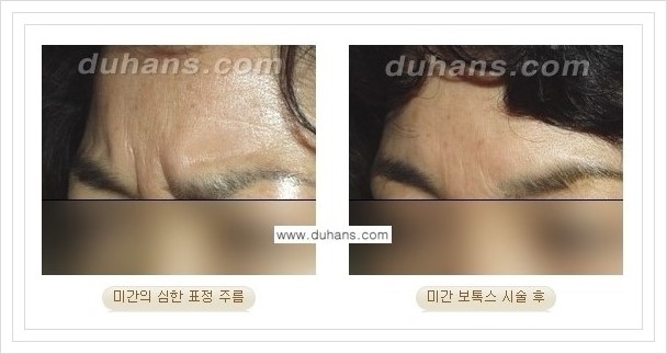[두한성형외과 경쟁력 Quick성형] - [주름교정을 위한 간편한 보톡스(보툴리눔톡신) 시술 안내] 관련 이미지 8