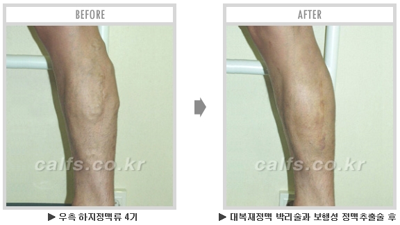 [종아리성형 두한성형외과] - [종아리수술에 대한 자주하는 질문과 답변 모음] 관련 이미지 20