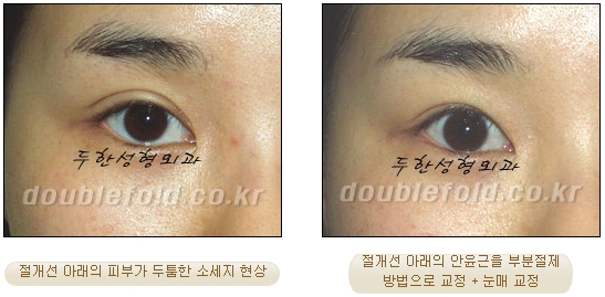 [Douhan Plastic Surgery Double Eyelid Revision] - [Correction of Uneven Eyes, Revision for Sausage Eyes, Ptosis Revision] image 11