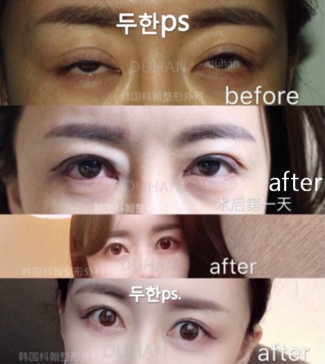 [두한성형외과 쌍꺼풀재수술]-[#높은라인 #눈매교정 #졸린눈 #게슴츠레한눈 #인라인 #흉터교정] 관련 이미지 1