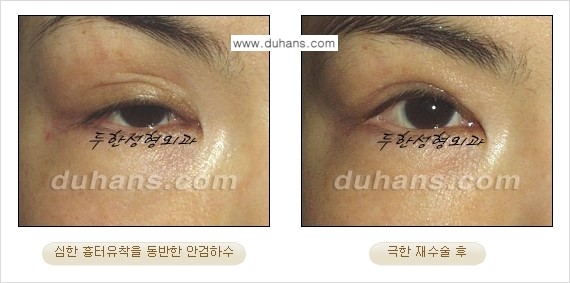 ⁠⁠⁠⁠[두한성형외과 성형 FOCUS] - [정상적인 눈매로의 복원 극한재수술 경우 ①] 관련 이미지 10