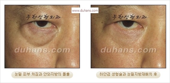 [두한성형외과 경쟁력 안검성형] - [젊어 보이면서 개선된 인상을 주기 위한 성형] 관련 이미지 33