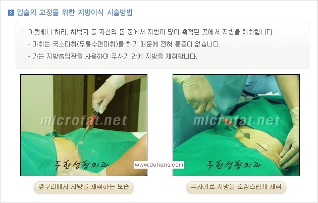 [두한성형외과 경쟁력 미세지방이식] - [입술 3차원 입체지방이식 안내 1.] 관련 이미지 4