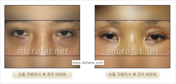 [두한성형외과 경쟁력 미세지방이식] - [타병원에서의 미세지방이식 이후 부작용 교정의 대상 안내] 관련 이미지 5