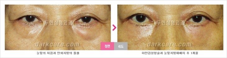 ​[두한성형외과 경쟁력 눈밑성형 리더] - [눈밑 다크써클의 증상, 원인, 종류, 치료방법 안내] 관련 이미지 64