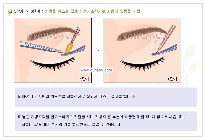 [두한성형외과 경쟁력 지방제거] - [윗눈꺼풀 지방제거, 아랫 눈꺼풀 지방제거  안내 1.] 관련 이미지 8