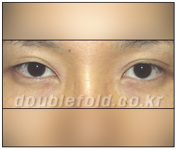 [두한성형외과 쌍커풀수술] - [눈성형 방법에 대한 자주하는 질문과 답변] 관련 이미지 204