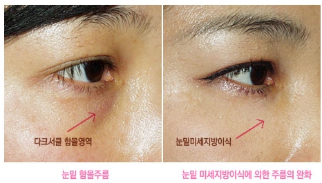 [두한성형외과 다크서클] - [다크서클 콜펫지방이식] 관련 이미지 19
