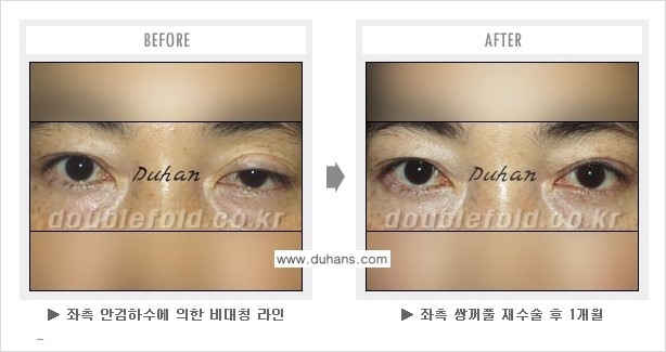 [두한성형외과 쌍꺼풀 재수술] - [피부 여유분이 부족해서 토안증이 발생한 경우] 관련 이미지 1