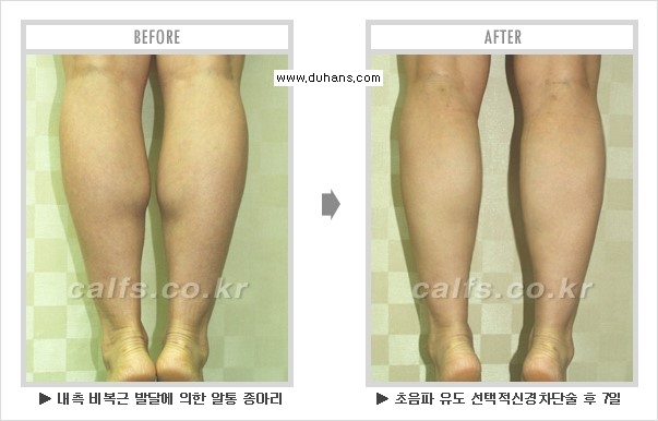 [두한성형외과 경쟁력 멀티종아리성형] - [종아리성형 전후 주의해야 할 내용 안내] 관련 이미지 13
