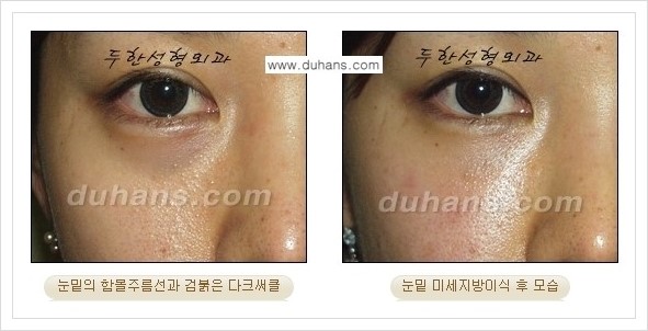 [두한성형외과 경쟁력 눈밑성형] - [다크써클과 눈밑주름을 위한 미세지방이식 안내] 관련 이미지 1