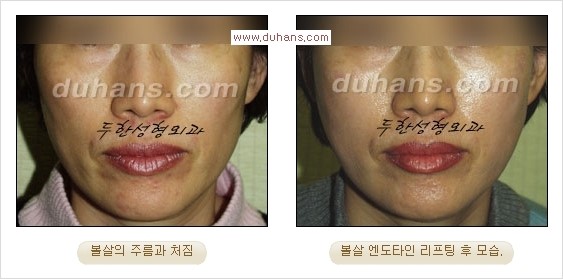 [두한성형외과 경쟁력 주름성형] - [눈썹거상, 앞볼처짐 개선의 엔도타인 리프팅] 관련 이미지 14