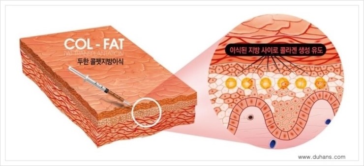 [두한성형외과 경쟁력 눈밑성형] - [눈밑이 전반적으로 함몰된 다크써클 교정 안내] 관련 이미지 17