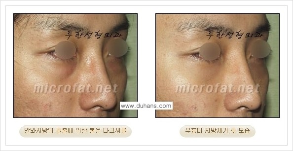 [두한성형외과 경쟁력 눈밑성형] - [눈밑지방제거, 눈위지방제거 안내 2.] 관련 이미지 10