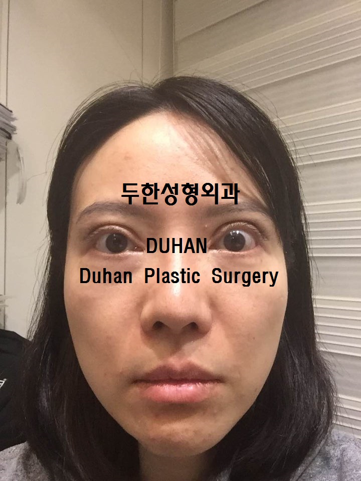 #극한눈재수술  #쌍꺼풀재수술 #눈수술입니다. #외반교정 #안검퇴축 관련 이미지 2