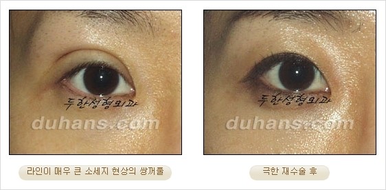 [두한성형외과 경쟁력 쌍꺼풀 재수술 리더 ] - [쌍꺼풀 재수술 과정, 쌍꺼풀 재수술 실패의 원인, 극한 재수술] 관련 이미지 20