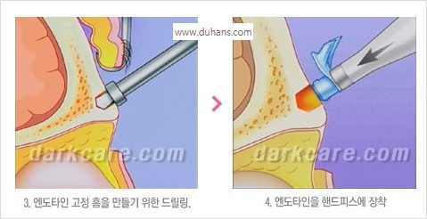[두한성형외과 경쟁력 동안성형 리더] - ​[미간주름, 이마주름, 안검성형, 이마거상술, 눈썹거상술] 관련 이미지 127