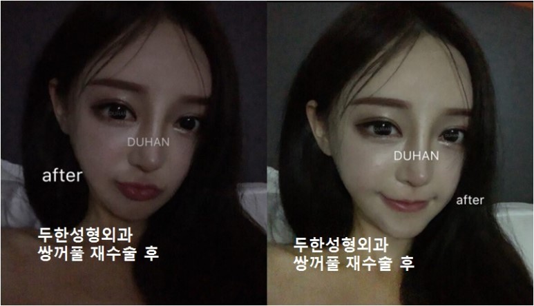 [안검하수 두한성형외과] - [졸리운 눈매, 안검하수눈매교정] 관련 이미지 25