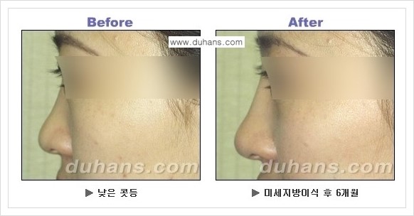 [두한성형외과 경쟁력 코성형] - [코높힘 미세지방이식 정보 안내] 관련 이미지 11