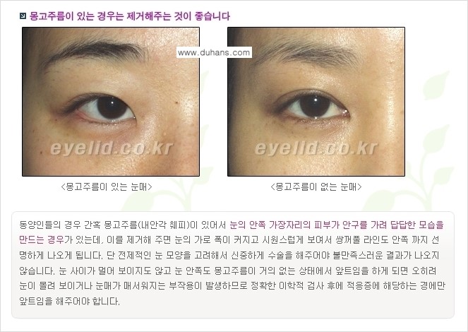 [두한성형외과 경쟁력 눈성형] - [퀵쌍꺼풀(부분절개법) 수술 안내] 관련 이미지 5
