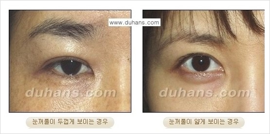​[두한성형외과 경쟁력 쌍꺼풀 재수술] - [아름다운 쌍꺼풀 선의 기준과 쌍꺼풀 재수술시 검사와 테스트 안내] 관련 이미지 4