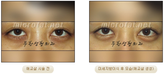 ​[두한성형외과 지방이식] - [애교살] 관련 이미지 18