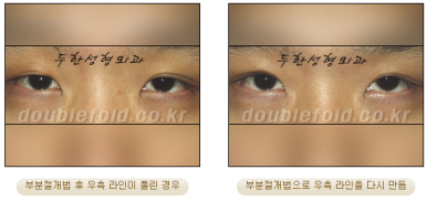 Best Place for Double Eyelid Revision Surgery, Duhan Plastic Surgery - Partial Incision Eye Revision Surgery image 34