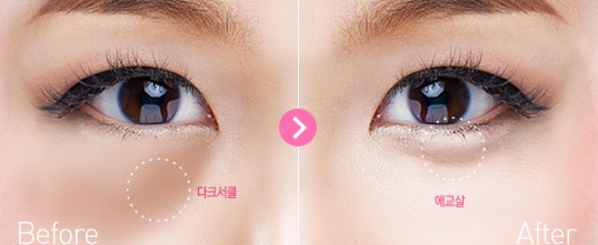 [Duhan Plastic Surgery Eye Area Surgery] - [Dark Circles and Aegyo-sal] image 2
