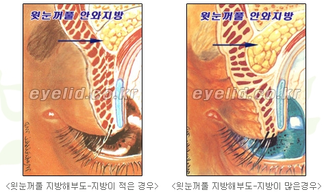 [두한성형외과 지방제거] - [눈두덩이지방제거, 눈밑지방제거] 관련 이미지 3