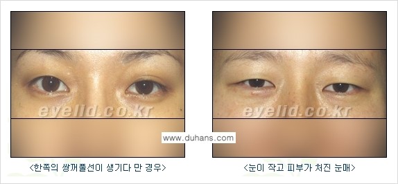 [두한성형외과 FOCUS 눈성형] - [퀵쌍꺼풀에 대한 질문과 답변들] 관련 이미지 1