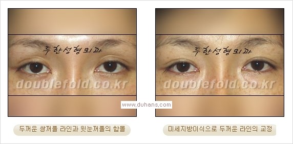 ​⁠⁠[두한성형외과 경쟁력 쌍꺼풀 재수술, 극한 눈재수술] - [지방이식으로 눈매와 쌍꺼풀 라인을 교정] 관련 이미지 9