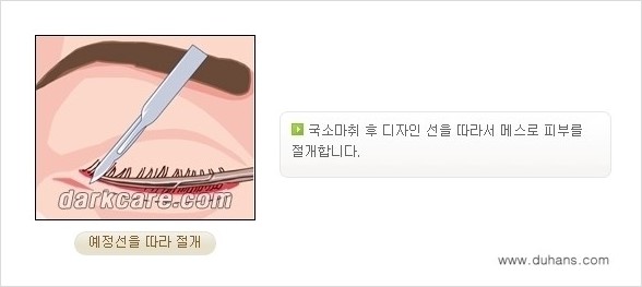 [두한성형외과 경쟁력 다크써클 교정] - [젊어 보이면서 개선된 인상을 주는 하안검 성형술] 관련 이미지 5