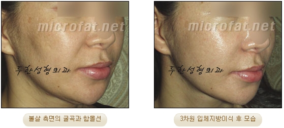 얼굴지방이식 두한성형외과 - 볼지방이식 관련 이미지 23