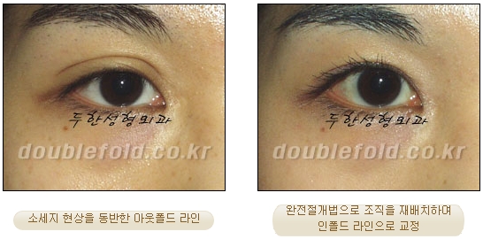 두한성형외과 쌍커풀 재수술 - 눈매교정 재수술 관련 이미지 62