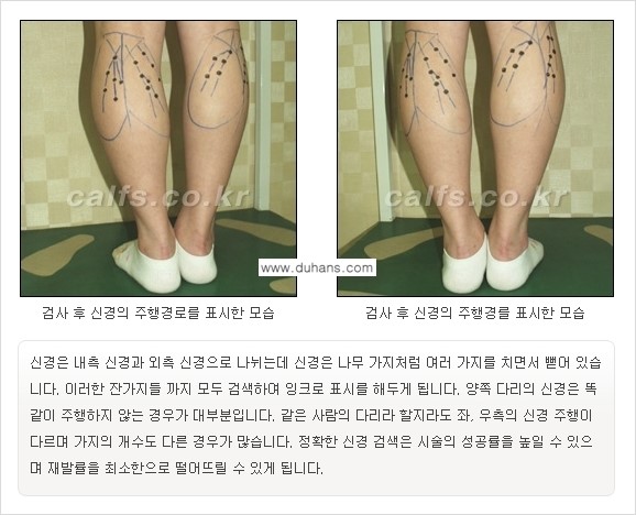 ​[두한성형외과와 날씬한 종아리 만들기!] - [간편하고 안전한 종아리 축소방법 ②] 관련 이미지 8