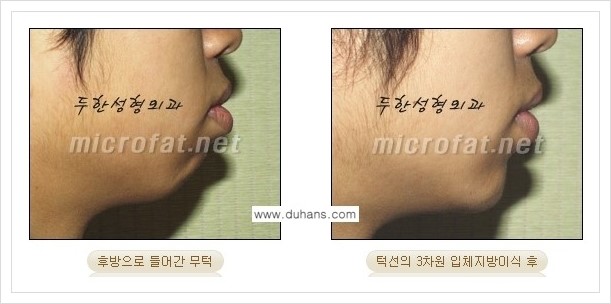[두한성형외과 경쟁력 안면윤곽 교정] - [미세지방이식으로 무턱, 작은턱, 오목턱, 턱선의 비대칭 교정 안내] 관련 이미지 5