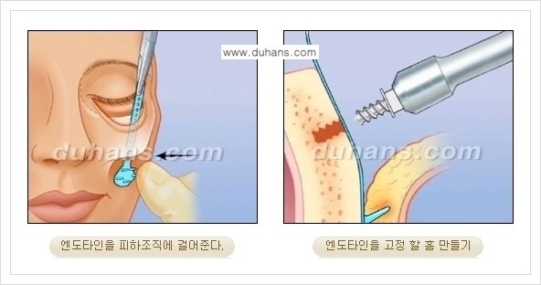 [두한성형외과 경쟁력 주름교정술] - [엔도타인 리프팅 안내 ③] 관련 이미지 9
