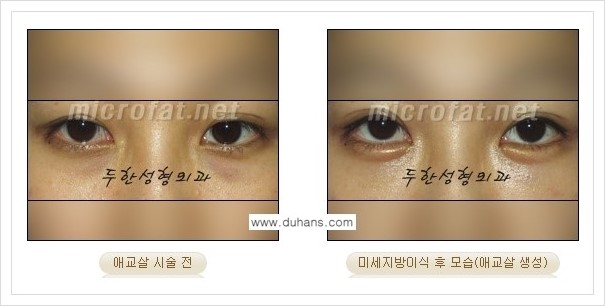 [두한성형외과 경쟁력 눈밑성형] - [애교살과 다크써클과의 관계] 관련 이미지 16