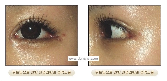 [두한성형외과 No.1 경쟁력] - [앞트임 복원 수술, 뒤트임 복원 수술] 관련 이미지 10