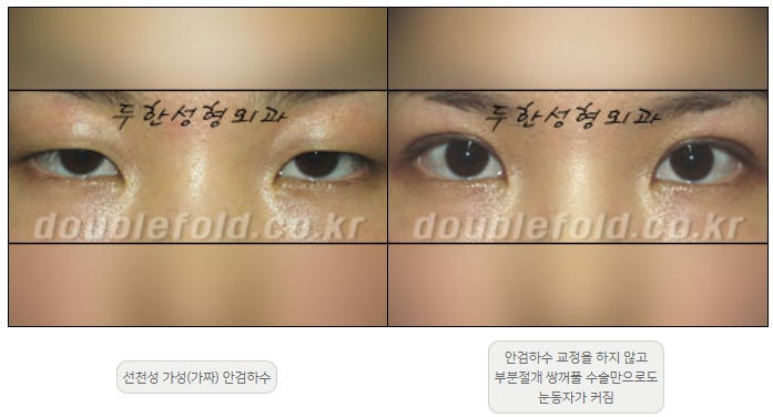 [Ptosis, Duhan Plastic Surgery] - [Sleepy-Looking Eyes, Ptosis Eye Correction] image 3