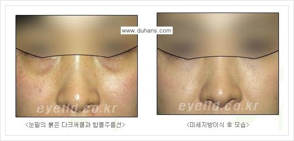 [두한성형외과 경쟁력 다크써클 교정] - [눈밑 돌출이 있으면서 그 아래 함몰 주름선이 있는 증상 개선 방법 안내] 관련 이미지 5