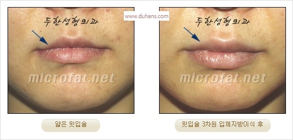 ​​[두한성형외과 경쟁력 미세지방이식] - [볼륨감 있는 입술성형] 관련 이미지 24